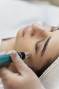 person getting micro needling beauty treatment (1)